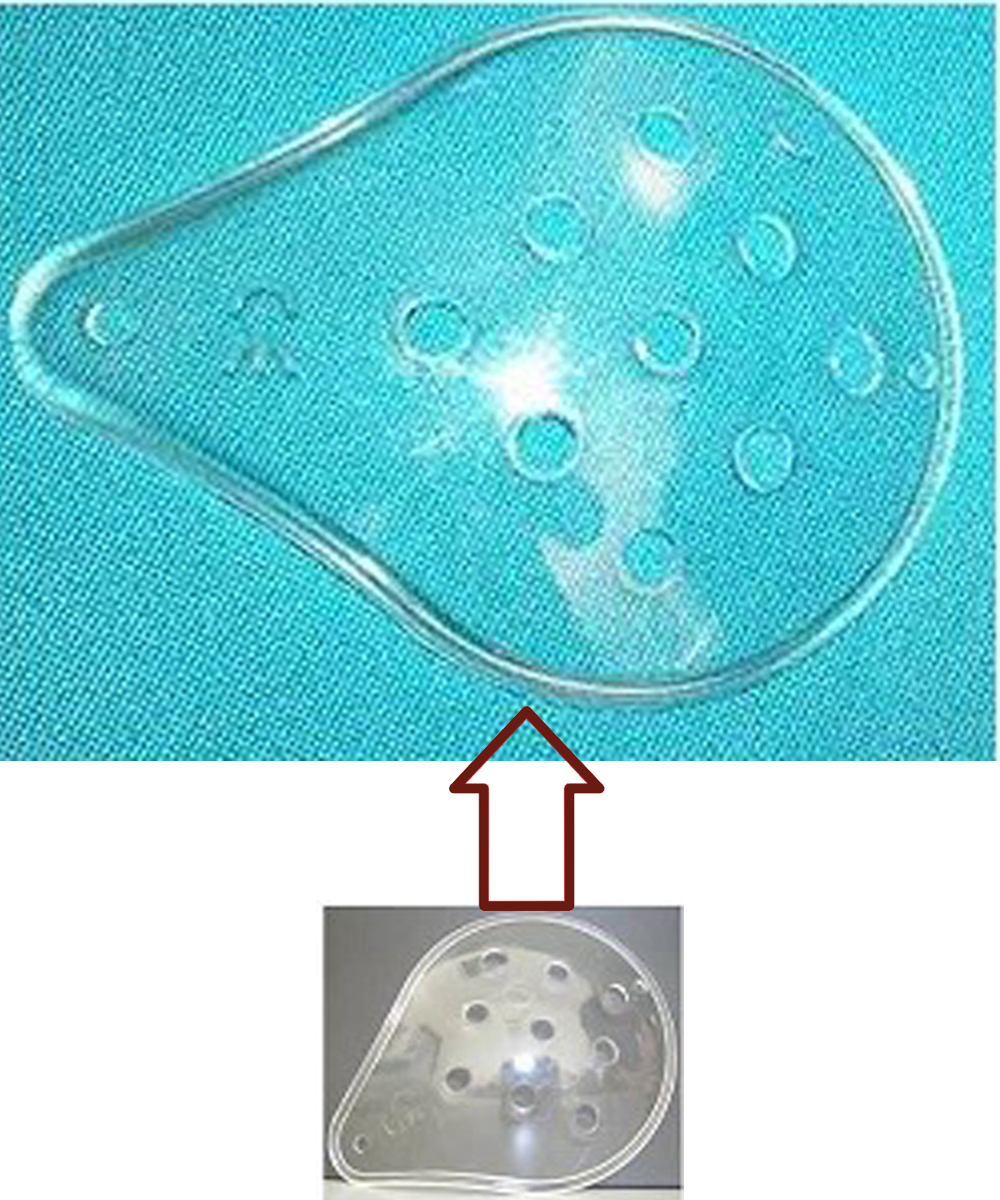 Mascherina monoculare protettiva post-operatoria in polietilene. Protegge l’occhio dopo interventi chirurgici. Dimensioni compatte per un comfort ottimale.