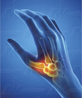 Epitact ortesi rigida da riposo mano dx mis. s 