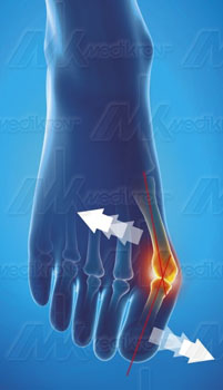 Epitact - ortesi  alluce valgo cipolla notturna ambidestro mis. s 